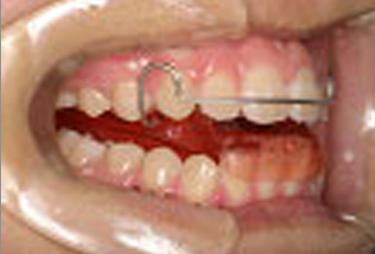 第１期治療 (乳歯が残っている患者様)