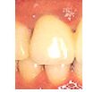 セラミッククラウンを入れた状態